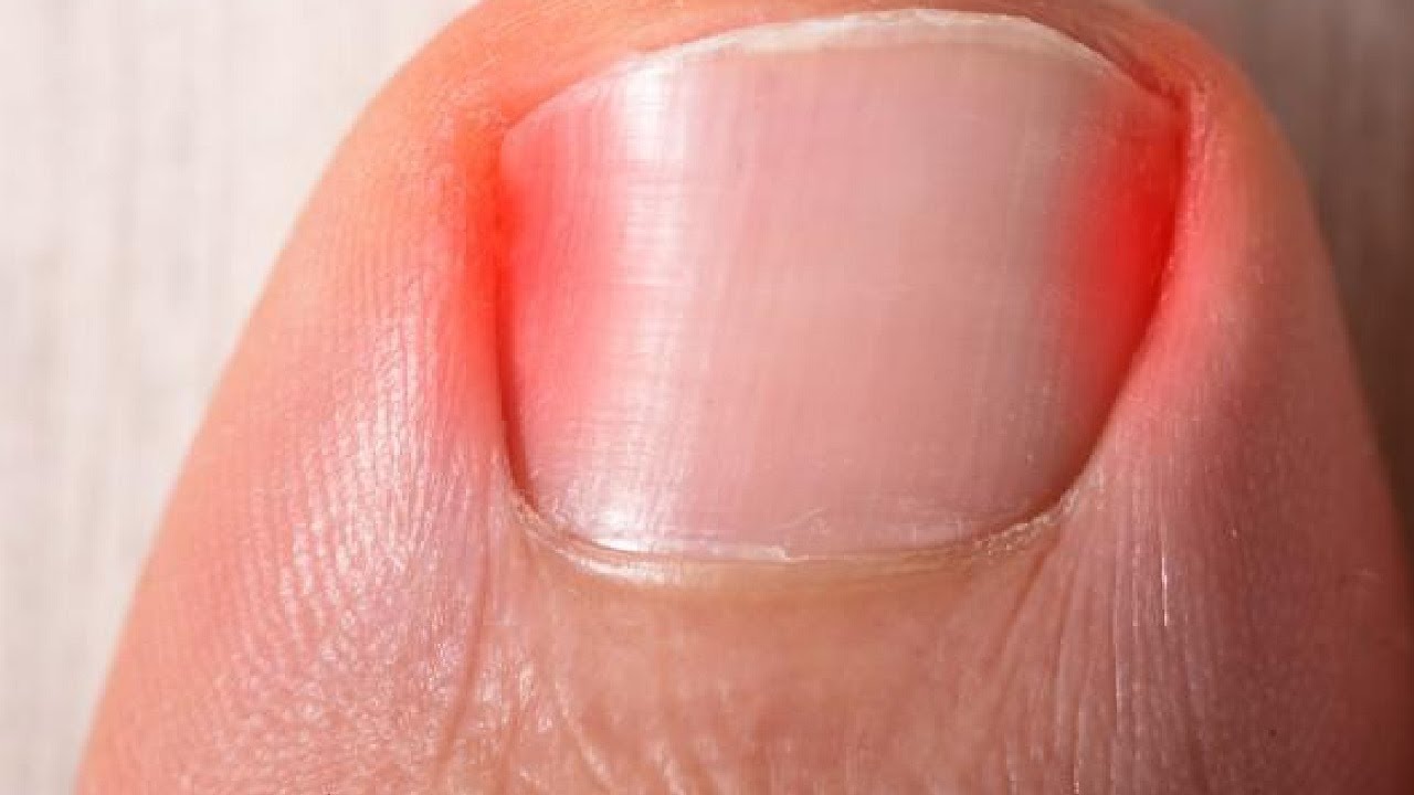 how to get rid of ingrown toenail for good overnight - YouTube