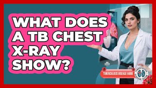 What Does A TB Chest X-Ray Show?