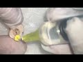 Final Rinsing Protocol irrigation of root canals mp3