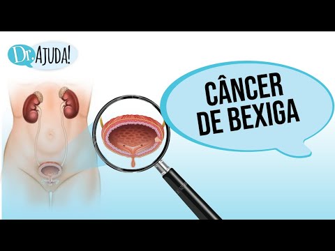 Vídeo: Trabeculação Da Bexiga: Tratamentos, Causas, Sintomas