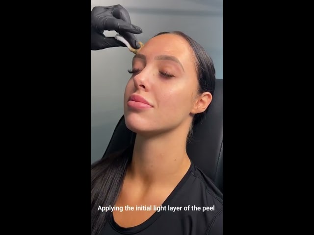 Applying a Chemical Peel