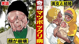 【奇病】マツボックリ病で...顔が崩壊した男。美女と結婚した。