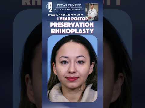 Video thumbnail: 1 Year Post-Op Preservation Rhinoplasty Subtle, elegant transformation