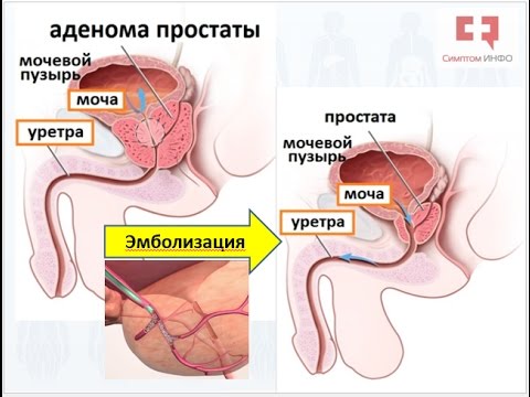 Аденома простаты: современная техника лечения аденомы эмболизацией артерий простаты