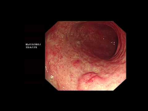 Video: Gastritis, Diafragmatiese Breuk - Volksresepte