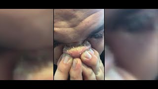 DIY Blackhead Removal Goes Viral DIY Blackhead Removal Goes Viral