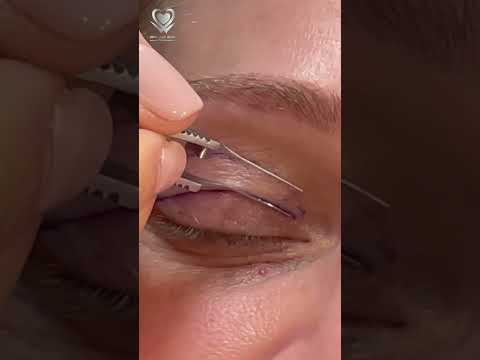 قص الجفن العلوي لأعادة الشباب والجاذبية لمظهرك  تجميل دبي  دبي الامارات