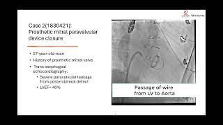 4 Challenging Cases In A Single Working Day In Cathlab No 8 Tavi, Paravalvular, Asd And Svc