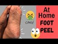 How to get rid of dry cracked heels at home | FOOT PEEL MASK