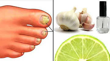 ¿Se puede llevar esmalte de uñas con hongos en las uñas de los pies?