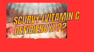 Scurvy Vitamin C Deficiency   Causes, Risk Factors, Signs & Symptoms, Diagnosis, And Treatment