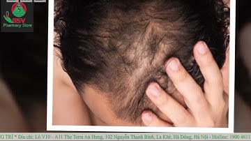 Xịt mọc tóc MINOXYL SOLUTION 3% (60ML)