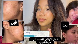 الحل النهائي للقضاء على حب الشباب|  Cutacnyl |قولي وداعا للحبوب screenshot 3