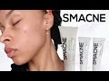 I TRIED SMACNE FOR 4 WEEKS - BEFORE AND AFTERS - ACNE PRONE SKIN