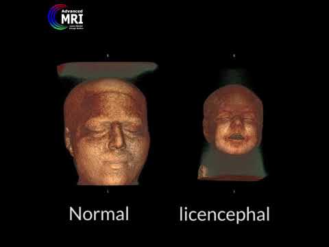 Video: Lissencephaly: Definiție, Simptome și Multe Altele