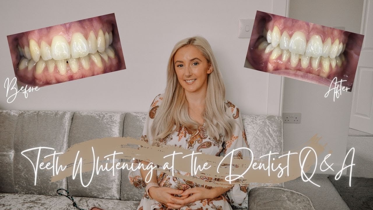 TEETH WHITENING AT THE DENTIST BOUTIQUE WHITENING REVIEW FACE DENTAL COVENTRY Isobel