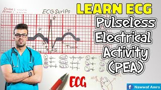 الايقاع الكاذب Learn ECG! Pulseless Electrical Activity (PEA).