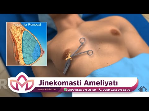 Jinekomasti Ameliyatı | Erkeklerde Meme Büyümesi Kesin Çözüm! | 3D Animasyonlu Anlatım