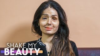 I Survived An Acid Attack | SHAKE MY BEAUTY