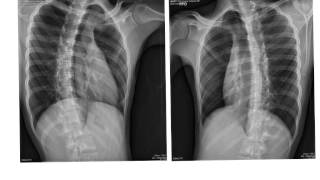 ribs