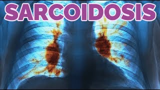 Sarcoidosis (updated 2023) - CRASH! Medical Review Series