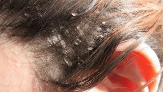 Hair eczema is good news for patients. How to treat seborrheic eczema  naturally. - YouTube