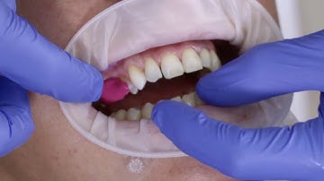 Kettenbach Futar D Fast Bite Registration