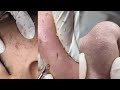 12 Minutes Of Top ASMR Pimple Popping Video
