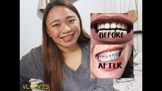 GUSTO MO DIN BA MAGPA BRACES? | USAPANG BRACES MASAKIT BA? :)