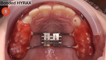 Tips for fixed retainer bonding, episode no.1  Quick orthodontic tips series
