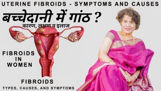 Fibroid Uterus Treatment, Symptoms in Hindi | बच्चेदानि में गाँठ या रसौली के कारण, लक्षण, इलाज