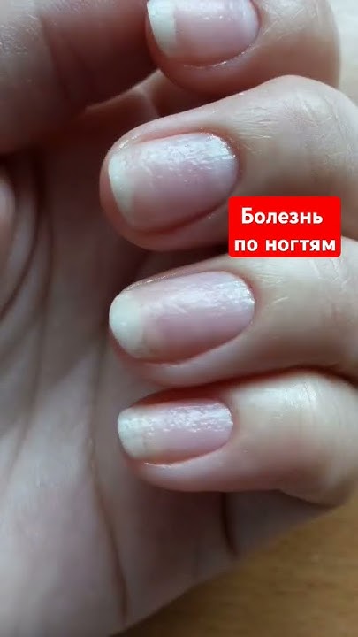 Определяем болезнь по ногтям. - YouTube