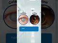 Vision Clarity Awaits! Transform Your Life with Advanced Pro-LASIK Surgery Now | Vision Eye Hospital