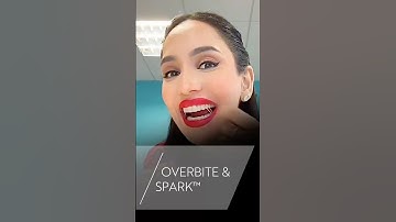 How @Amenakhan corrects her overbite with Spark™ Clear Aligners 🪢