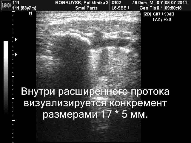 Сиалолитиаз