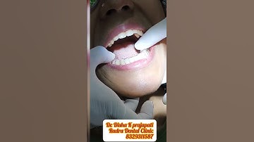 Invisalign #aligners #shorts #trending #viral #ytshorts #teeth #dental #dr #youtubeshorts