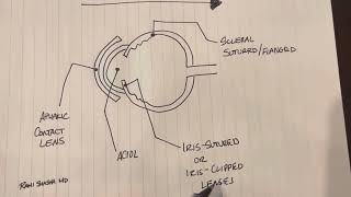 Anatomical Approach In The Management Of Aphakia - Dr. Rami Shasha Md