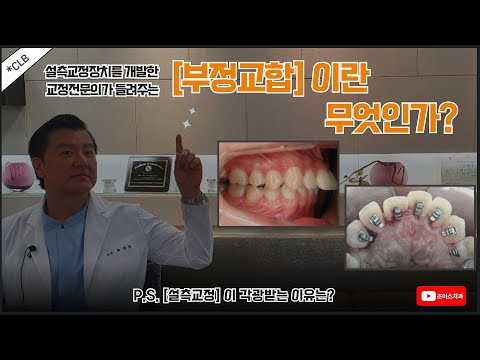 [Chois Orthodontic Clinic] What is (Malocclusion/Crossbite)?