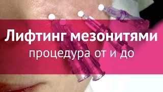 картинка: Подтяжка лица мезонитями: процедура от и до