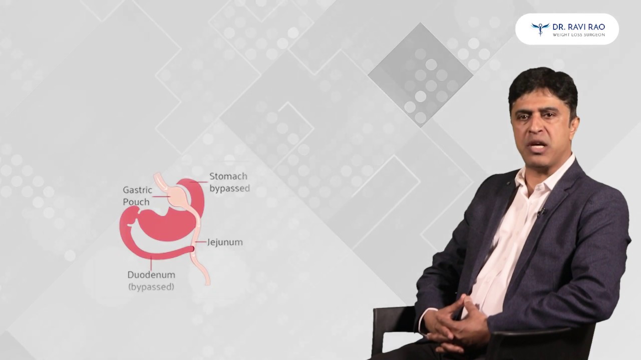 Rny Gastric Bypass Surgery Gastric Bypass Most Common Bariatric Surgery Procedure Dr Ravi Rao Youtube Rny Gastric Bypass Surgery Gastric Bypass Most Common Bariatric Surgery Procedure Dr Ravi Rao Youtube