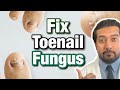 How to Treat Toenail Fungus CORRECTLY | Easy Steps (2021)