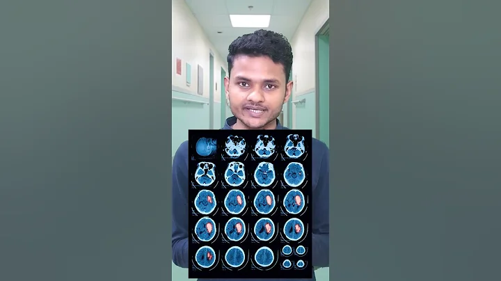 Brain hemorrhage patient #faltumedico #shorts