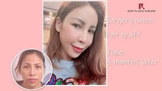 Full Face Fat Graft By Ruby Plastic Surgery