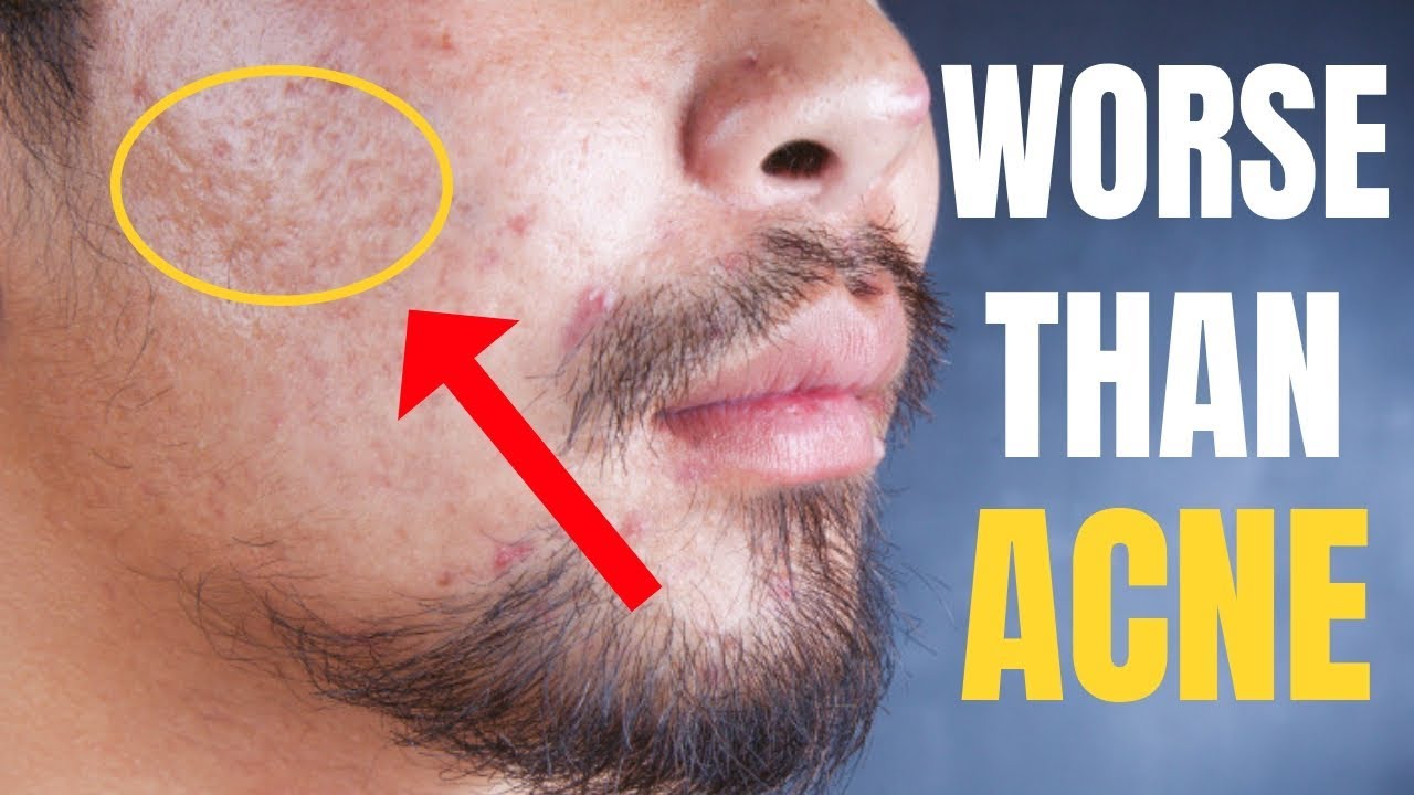 mens fashion corporativo THIS is WORSE Than Acne!