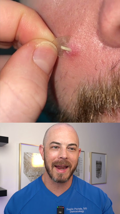 Derm reacts to perfect pimple patch removal! #satisfying #pimplepatch #dermreacts #doctorreacts