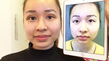 Tạo Mắt Cười Siêu Xinh Sau Khi Cắt Mí Mani Open Deep Tại Dr.Hải Lê.