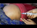 Intramuscular injection buttock in hindi  injection injection ep 113