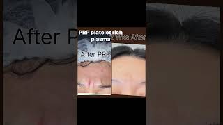 The best serum in the world for your face "Follow me for more "#prp #follower #health #hydrafacial