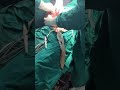 laparotomy