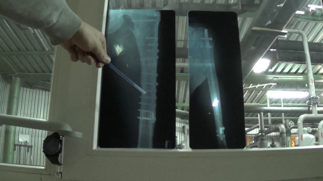 Титановая пластина в ноге и спица в руке